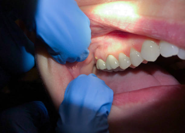Best Emergency Tooth Extraction in Offutt Af, NE