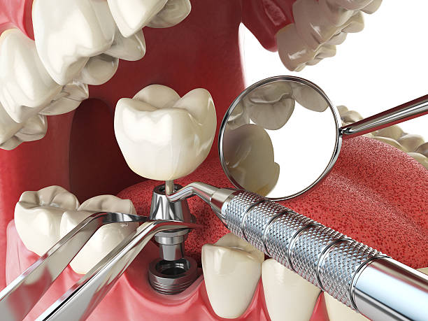 Best Emergency Dental Care for Broken or Chipped Teeth in Offutt Af, NE